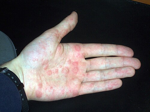 A severe pompholyx flare on the palm of the hand, showing clusters of dyshidrotic eczema blisters that have merged together