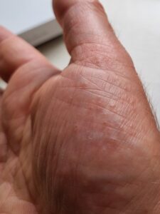Andy Brown's right hand showing a mild pompholyx flare, May 2026