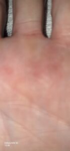 Dyshidrotic eczema on the hand