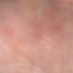 Dyshidrotic eczema on the hand